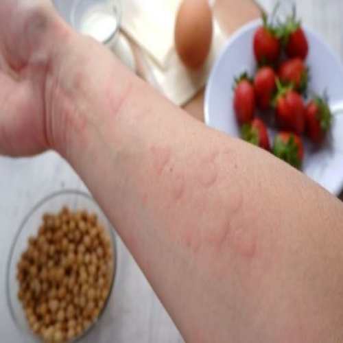 نقش تنوع غذایی در پیشگیری از آلرژی‌های غذایی جدید