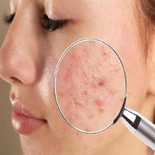 نقش تغذیه در پیشگیری از آکنه و مشکلات پوستی